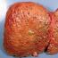 Жировая дистрофия печени — симптомы и лечение